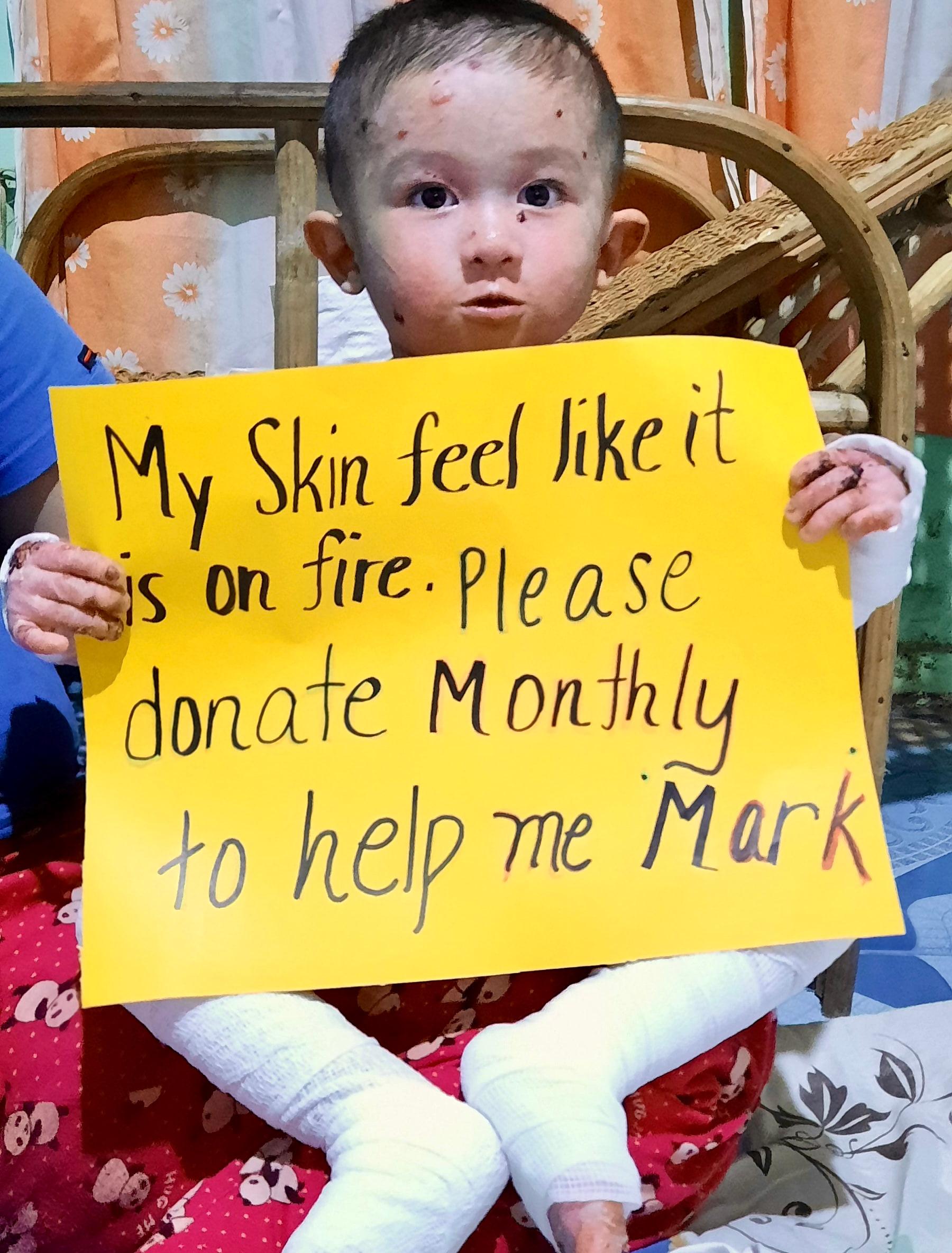 Mark Christan lives with pain no child should have to endure