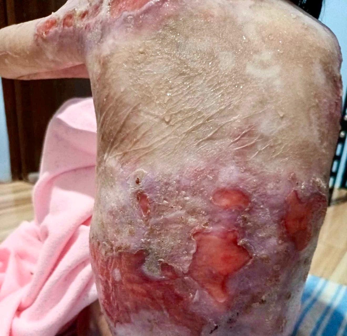 Shamila lives with pain no child should have to endure