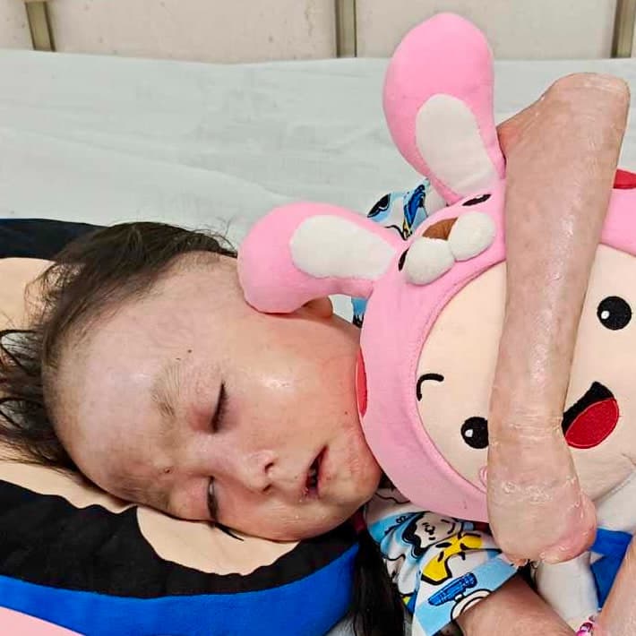 Shamila lives with pain no child should have to endure
