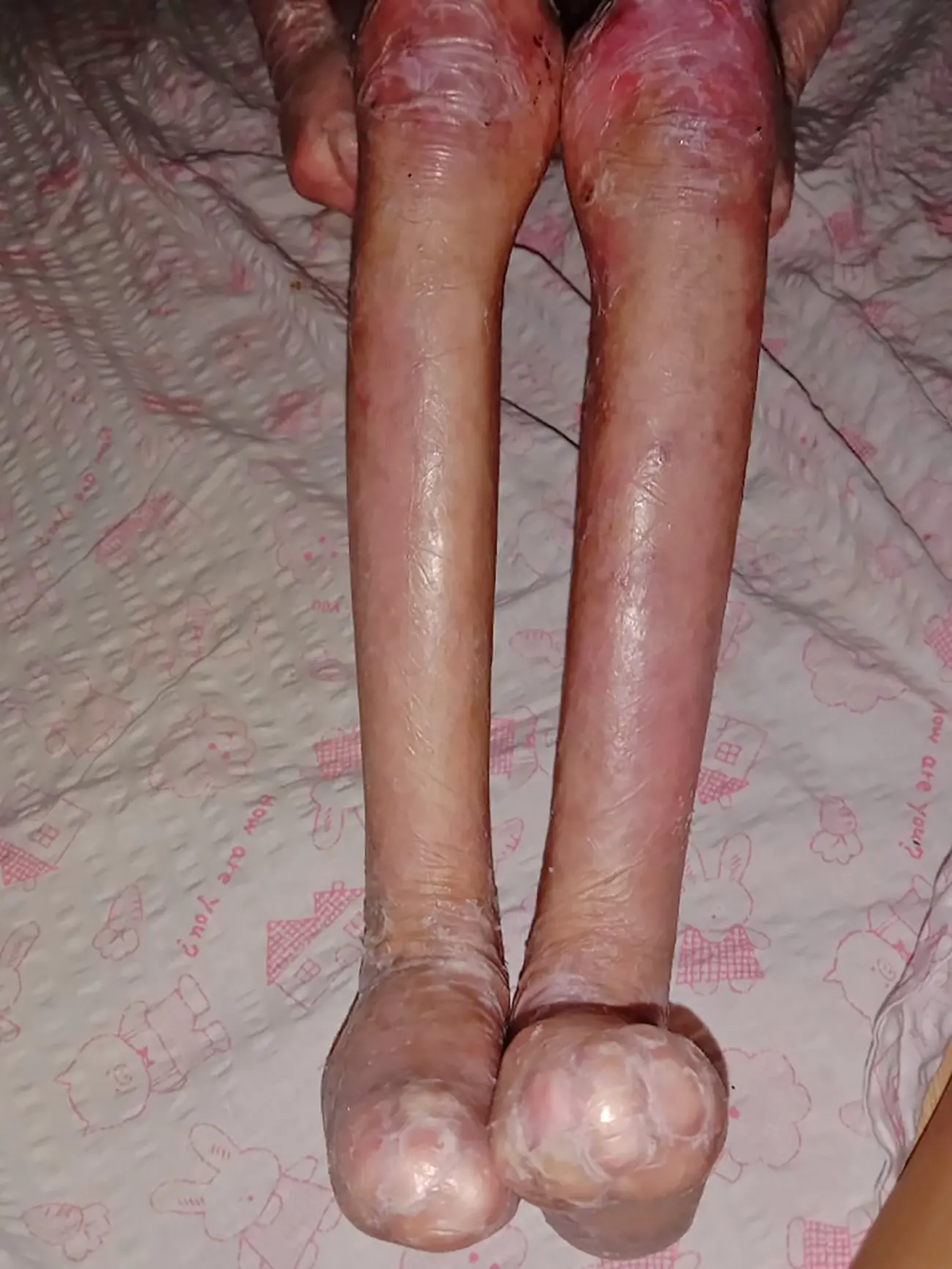 Shamila lives with pain no child should have to endure